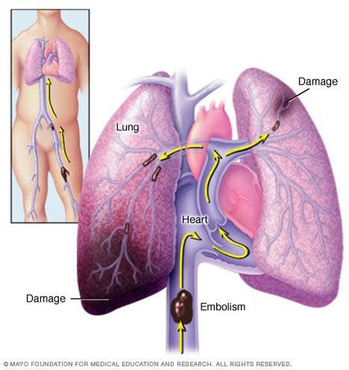 Diagnosis of pulmonary embolism