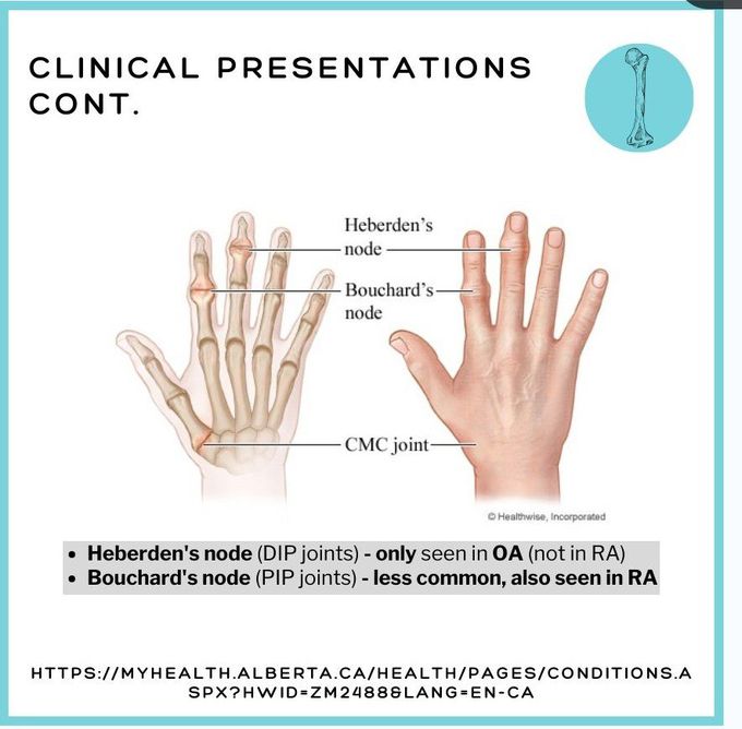 Osteoarthritis IV