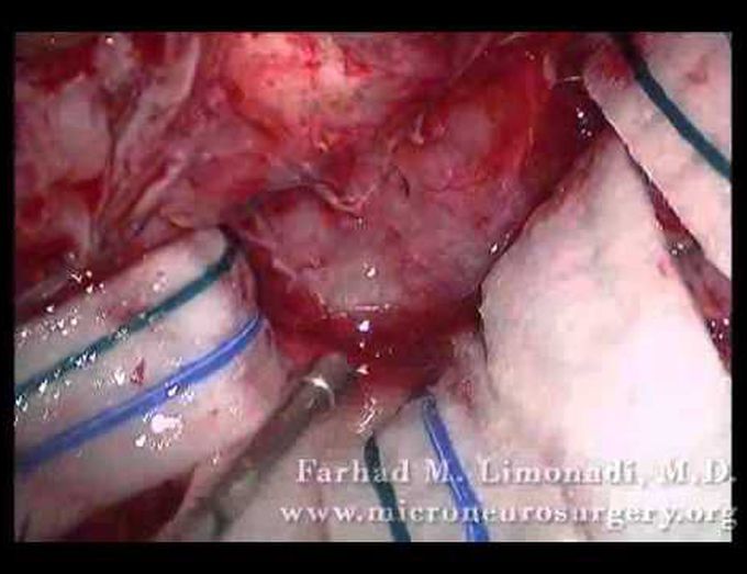 Neurosurgery on Meningioma Brain Tumor