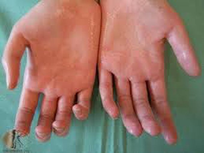 Treatment of Hyperhidrosis