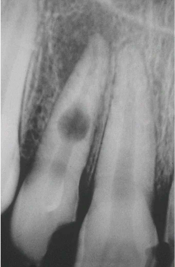 Internal resorption