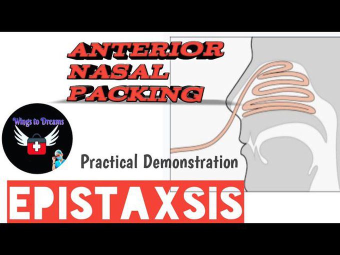 ANTERIOR NASAL PACKING - EPISTAXSIX PRACTICAL DEMONSTRATION