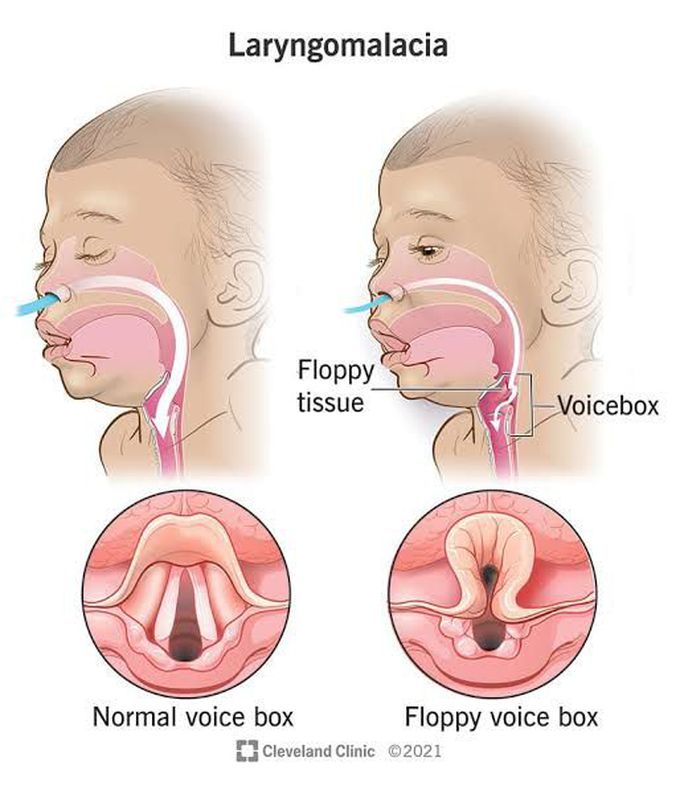 Diagnosis of laryngomalacia