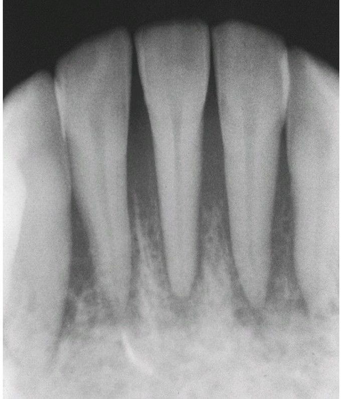 Carcinoma Metastatic to the Jaws.