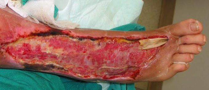 Necrotising Fasciitis