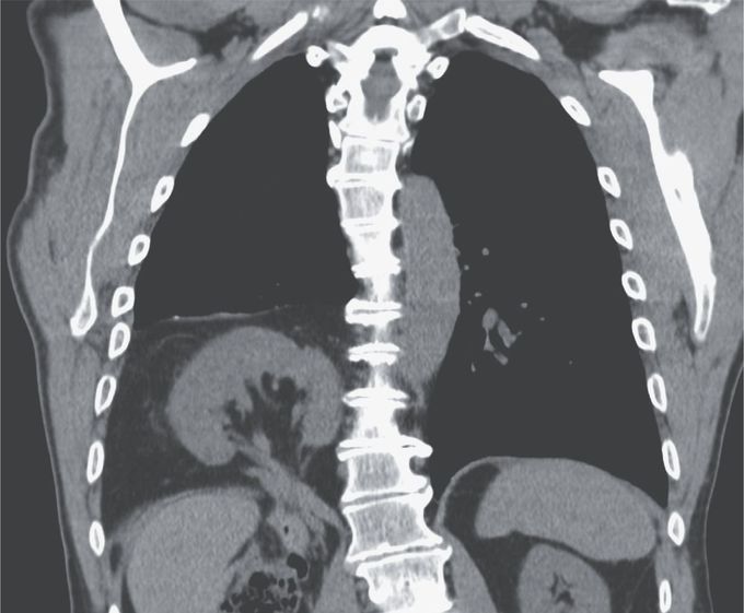 Ectopic Kidney