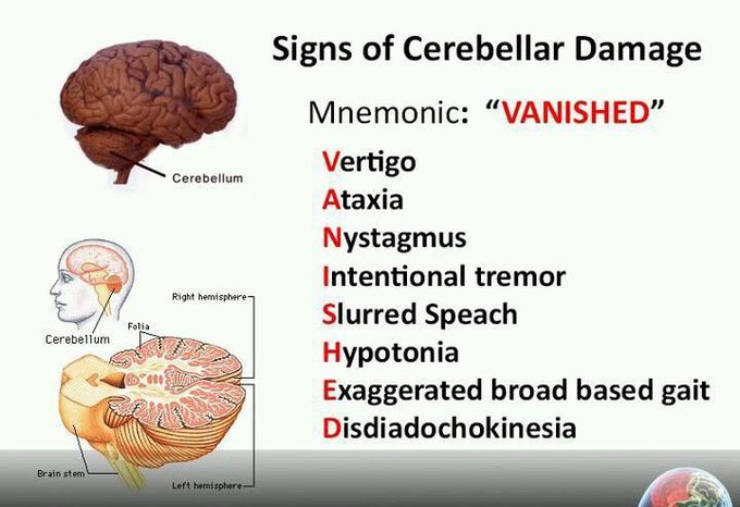 Signs of Cerebellar Damage | Mnemonic