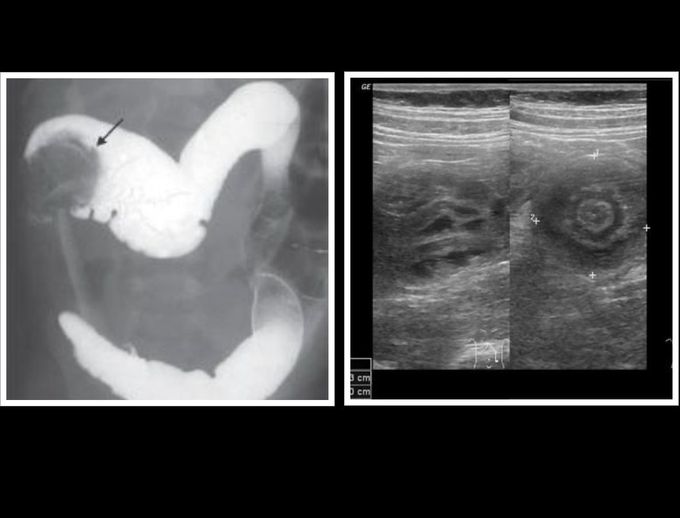 Recognising the Obstructed Bowel - Intusussception