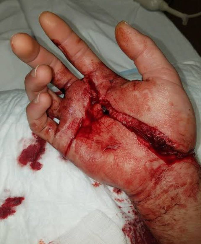 We must educate workers before handling them a machine work to avoid such major injuries, as crushing injuries are the worst i have seen n almost are sometimes life consuming