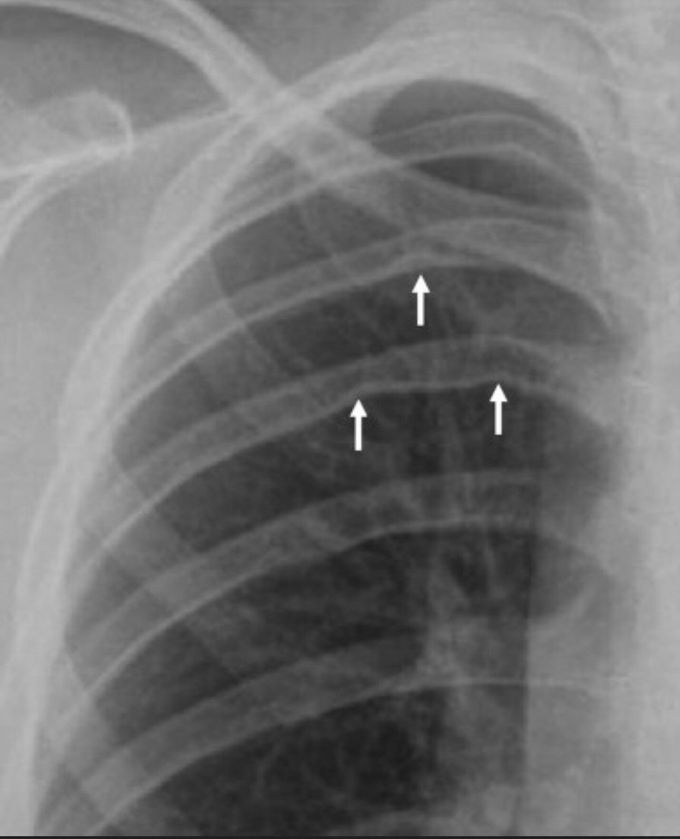 What's the name of pointed area? What's the name of disease??