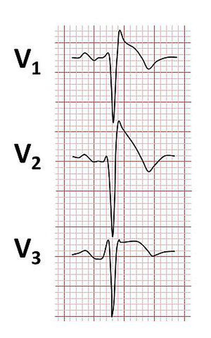 Causes of brugada syndrome