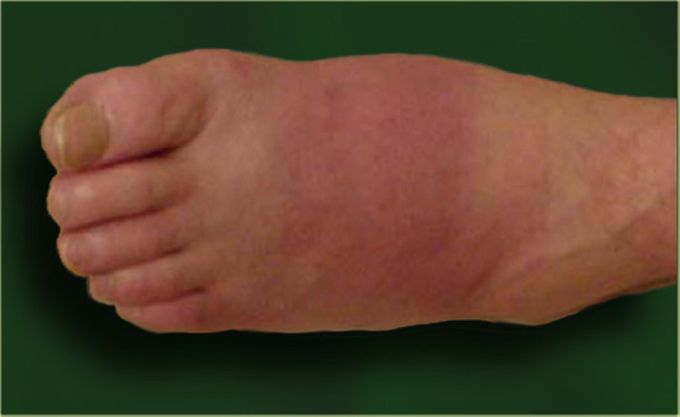 Diabetic neuropathic arthropathy