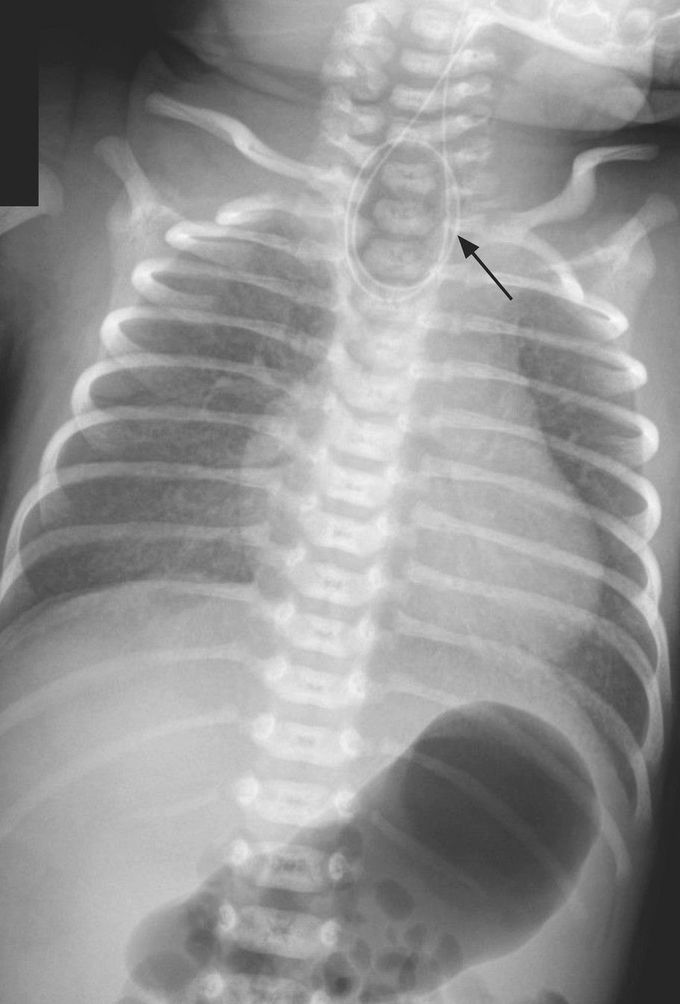 Esophageal Atresia