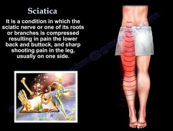 What is Sciatica?
