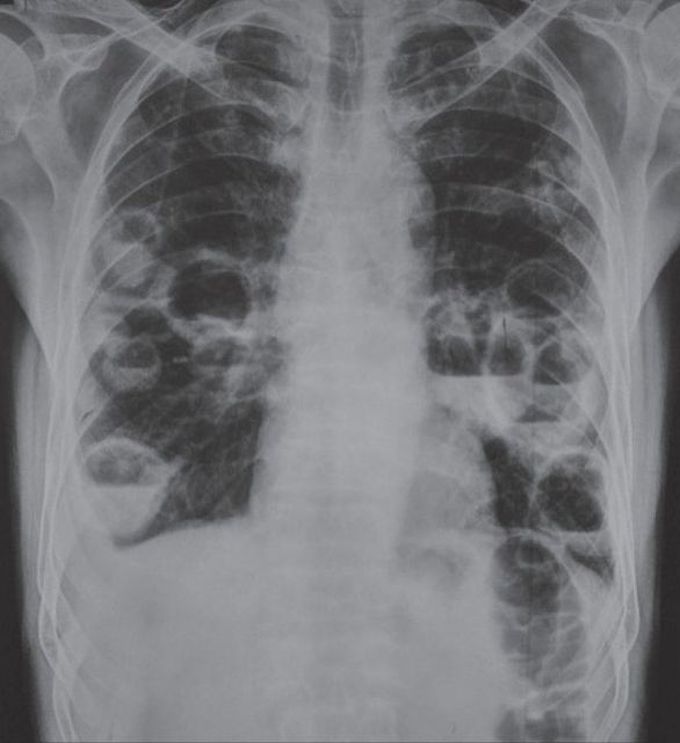 CXR showing Multiple Lung Abscesses