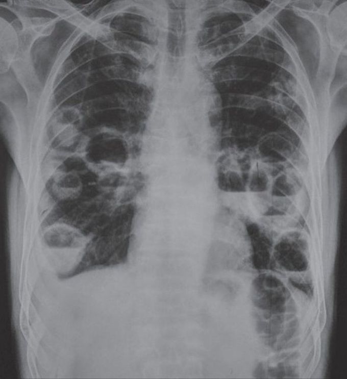 CXR showing Multiple Lung Abscesses