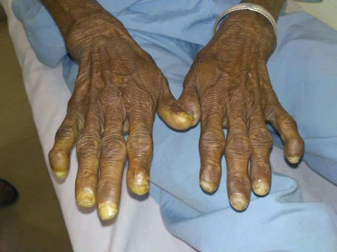 What is this condition called??