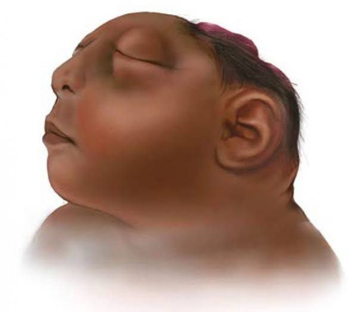 Anencephaly