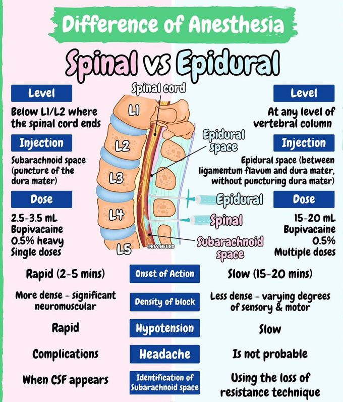 Spinal Vs Epidural