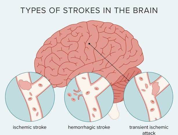 How Many Types Of Stroke Occur In Human Beings