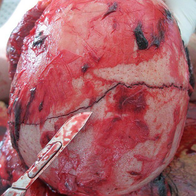 Fissure fracture