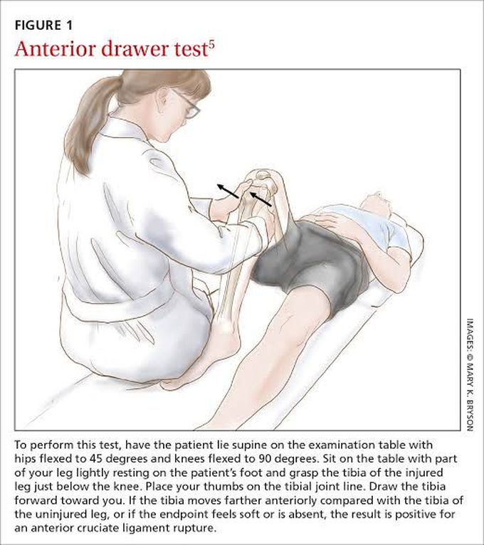 Anterior Drawer Test