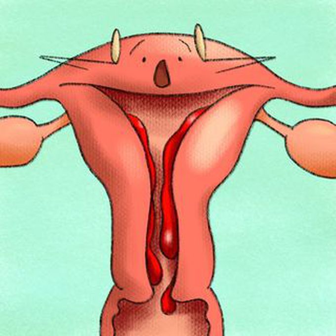Causes of Abnormal Uterine Bleeding (AUB)