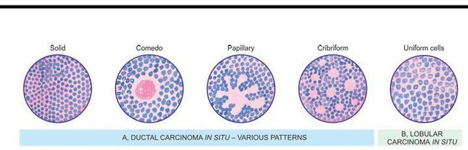 In situ carcinoma of breast