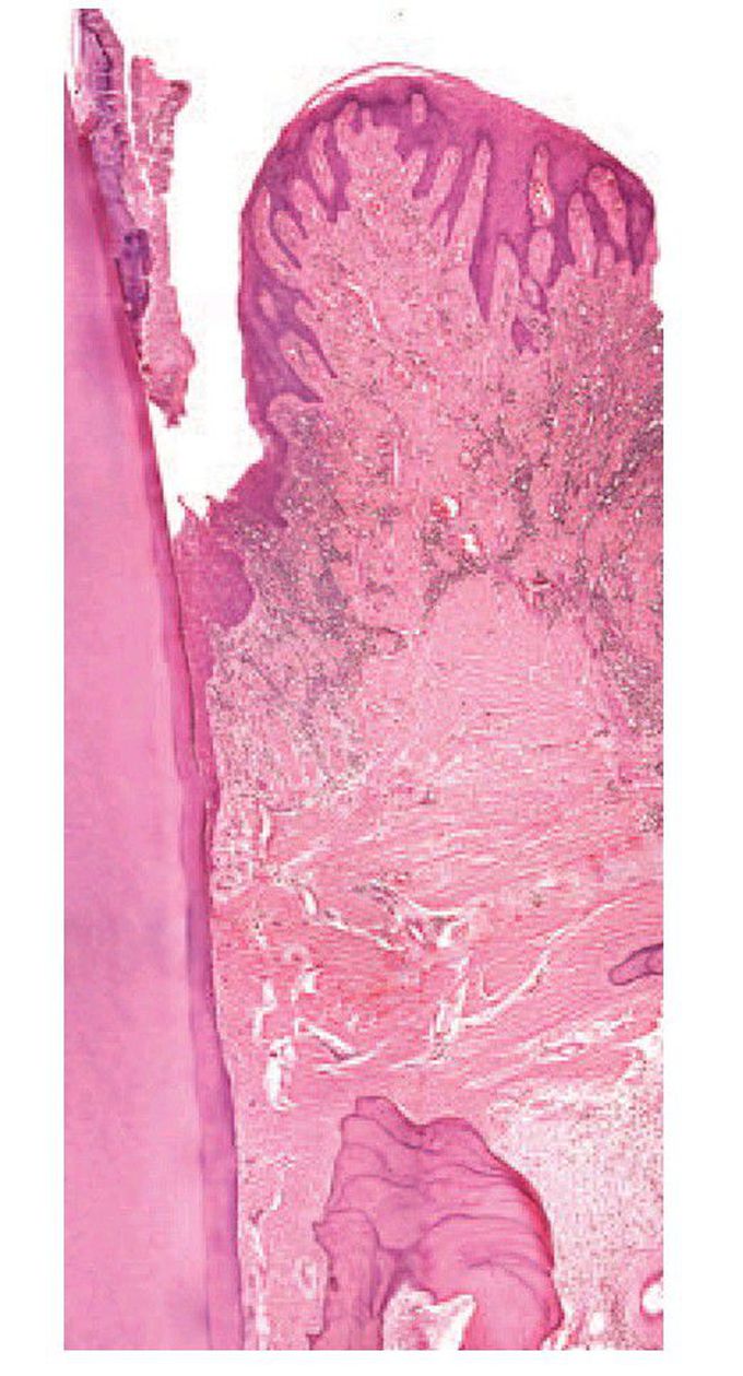 Chronic periodontitis.