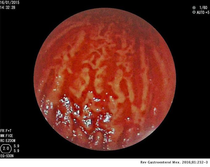 Watermelon Stomach