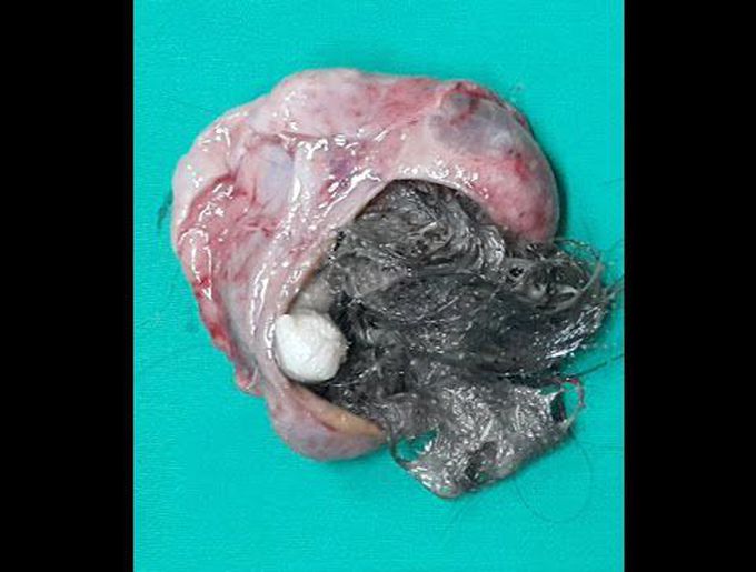 HAIR AND BONE FOUND IN OVARIAN TUMOUR