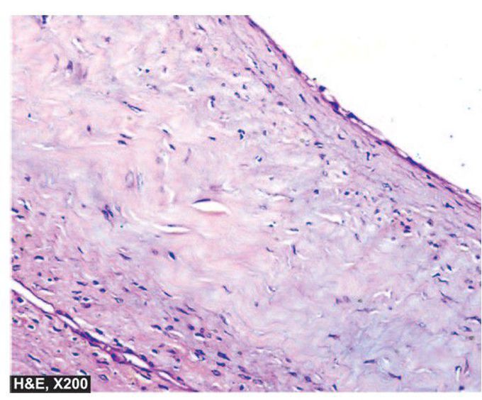 Cyst of ganglion.