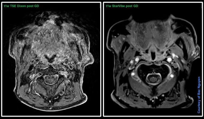 Amazing power of STARVIBE @ Siemens 3T Skyra Head neck area - MEDizzy