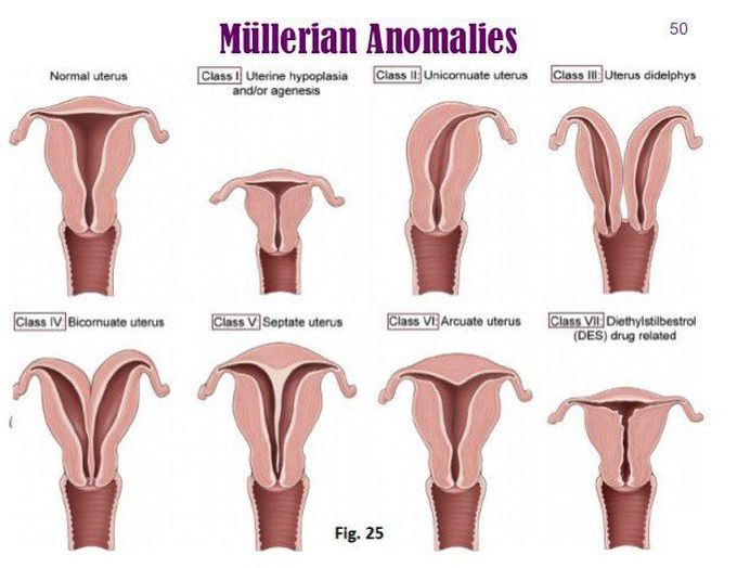 Mullerian anomalies