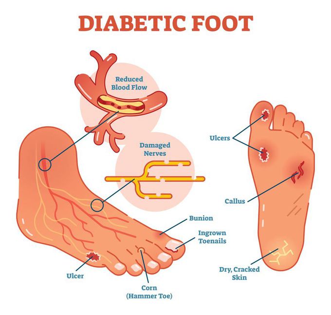 diabetic-foot-medizzy