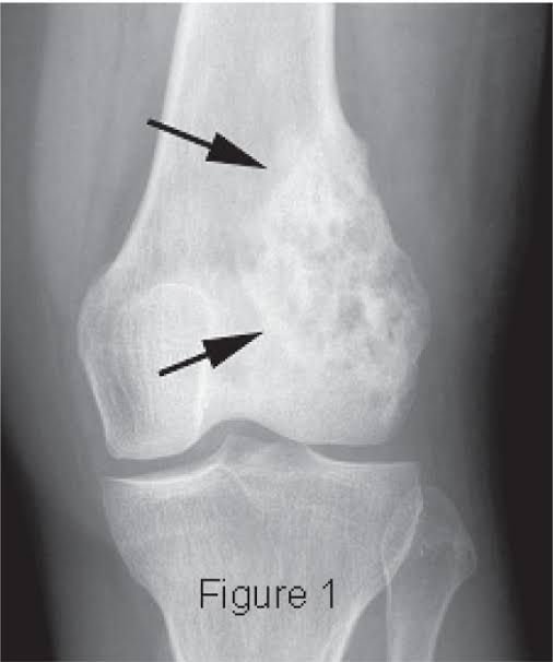 Signs and symptoms of osteosarcoma - MEDizzy