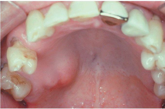 Salivary Adenocarcinoma