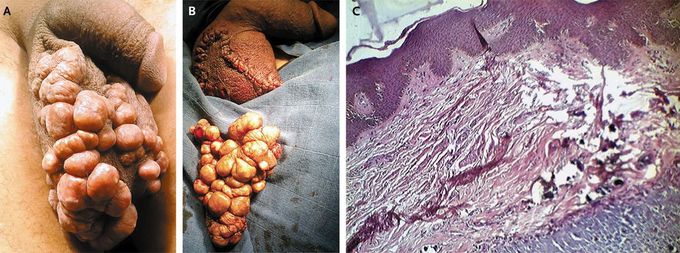 Scrotal Calcinosis