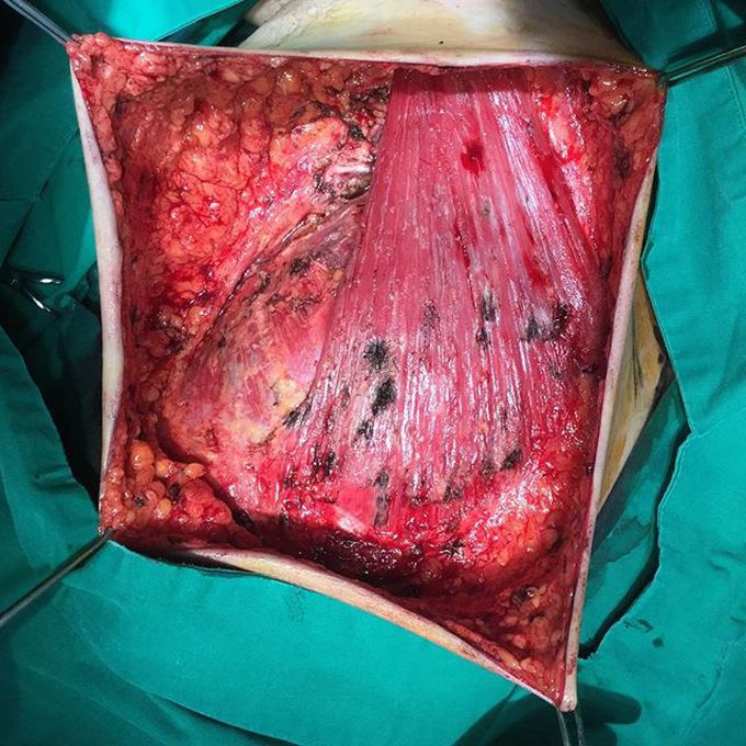 Modified radical mastectomy