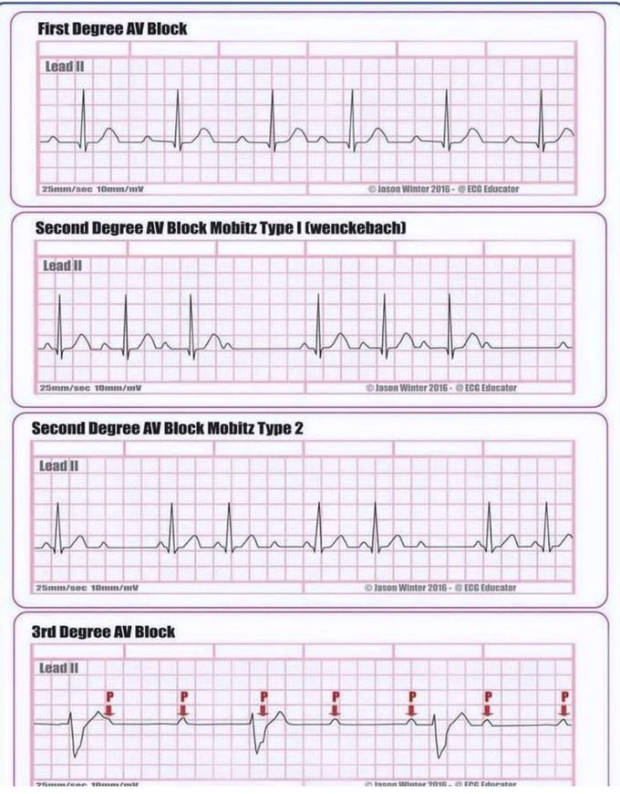 Types of AV Block