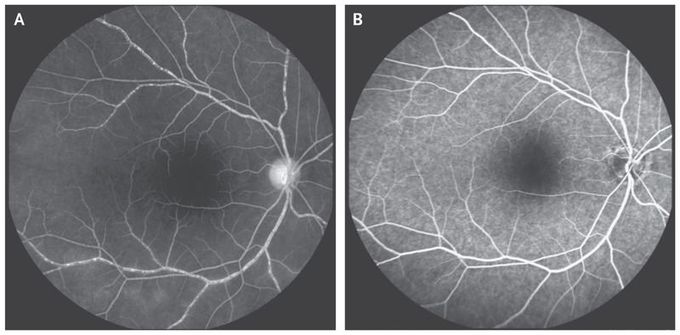 Retinal Vasculitis in Takayasu’s Arteritis