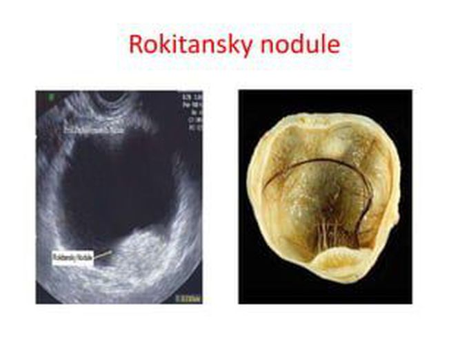 What is a Rokitansky nodule in the ovary?