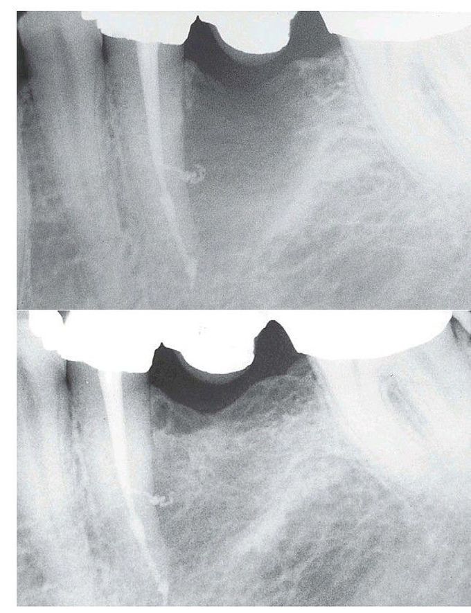 Bony defect in alveolar bone