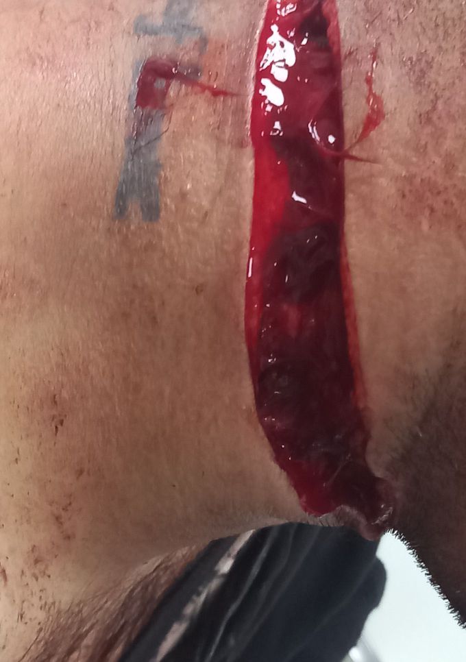 Cut wound at neck