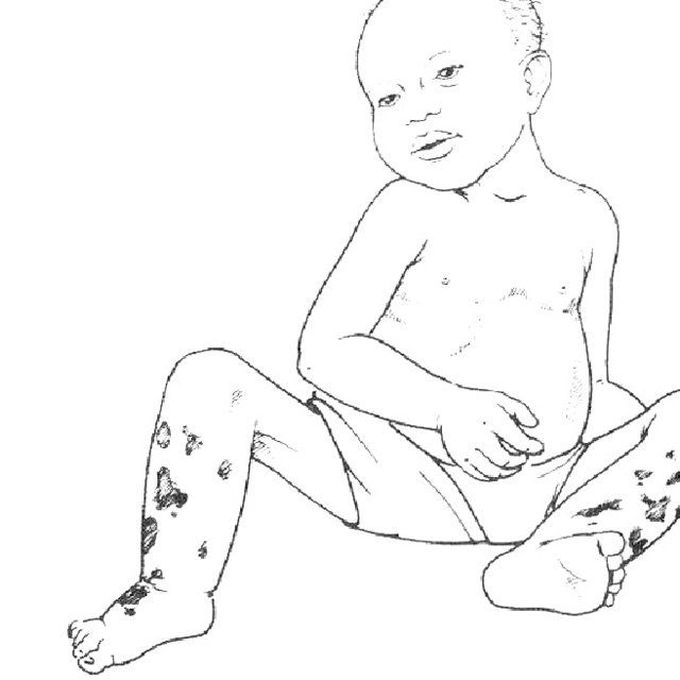 Kwashiorkor