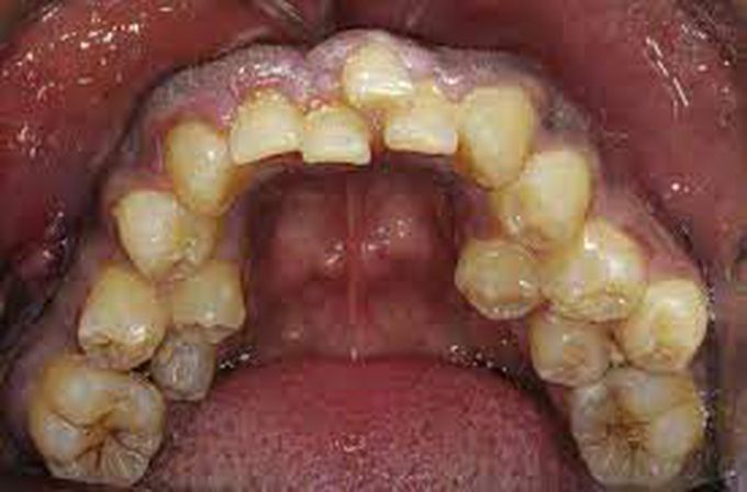 What causes hyperdontia?