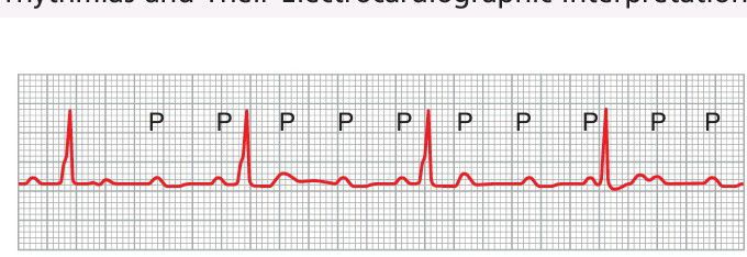 Complete heart block