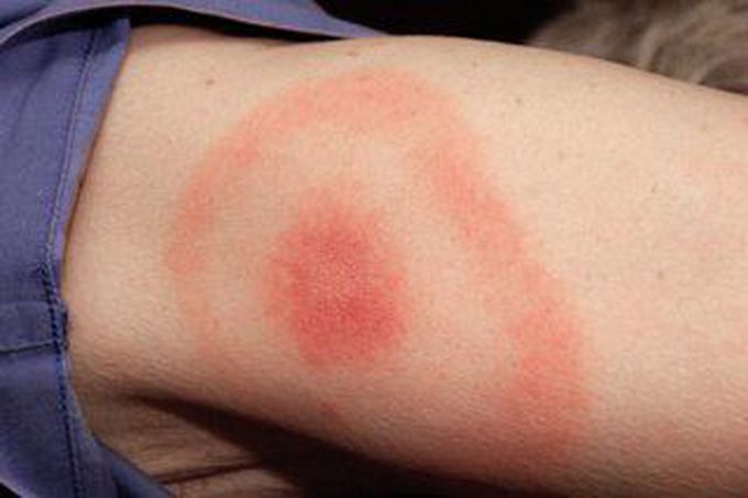 Causes of Lyme Disease