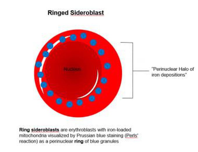 Ringed Sideroblasts