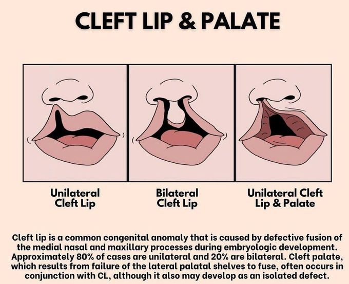 Cleft Lip and Palate